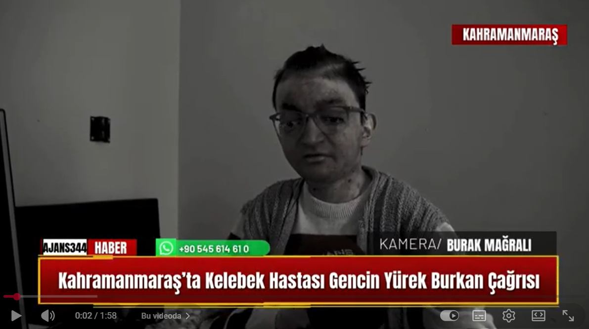 Kahramanmaraş'ta kelebek hastası gencin yürek burkan çağrısı